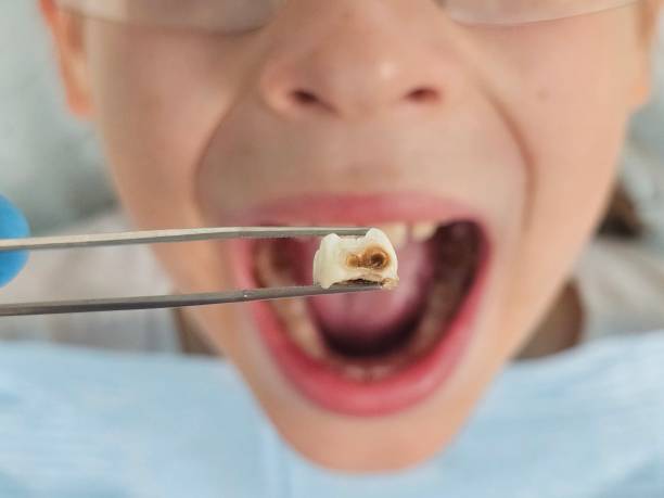 Best Chipped Tooth Repair Near Me  in Kingston, NJ
